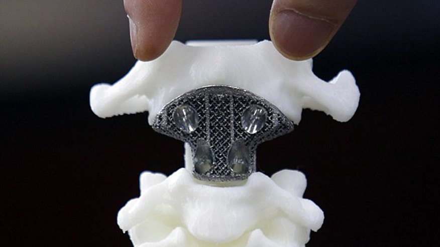 First-ever 3D-printed Vertebra Implanted In 12-year-old Cancer Patient ...