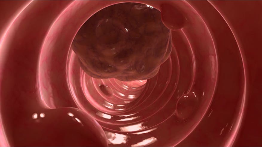 660colontumor.jpg