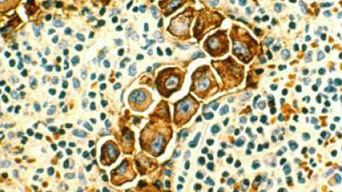 Stopping cancer's spread: New protein found to control cancer metastasis