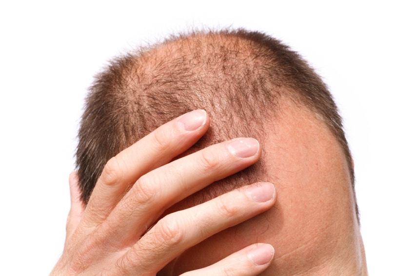 Foods that prevent hair loss: How to get the 7 essential anti-balding nutrients