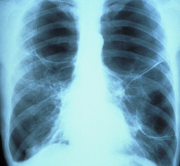 lung-xray-110603.JPG