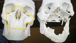 A -year-old Polish man received a life-saving total face transplant just three weeks after being disfigured in a workplace accident, in what his doctors said Wednesday is the fastest timeframe to date for such an operation.