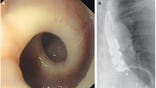 An -year-old Swiss woman who suffered painful spasms in her chest turned out to have an esophagus that twisted itself into a corkscrew shape whenever she swallowed, according to a report of her case