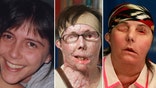 A Vermont woman who was disfigured after her ex-husband doused her with industrial strength lye in  has revealed her new face.