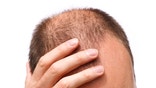 It's true that men are more likely to lose their hair than women, mostly due to male pattern baldness (more on that later). But thinning hair and hair loss are also common in women, and no less demoralizing.

Here are some common and not-so-common reasons why you might be seeing less hair on your head.