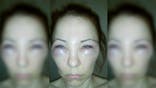 Woman gets snake venom injection instead of Botox