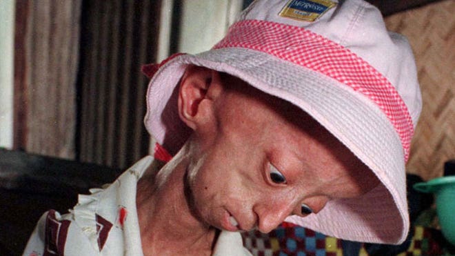 Progeria