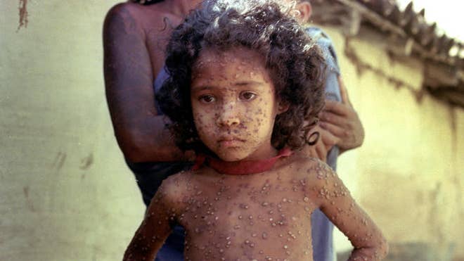 Smallpox