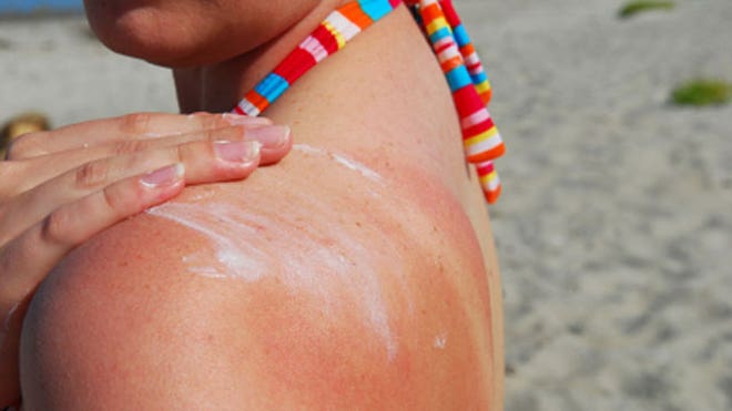 Sunburn