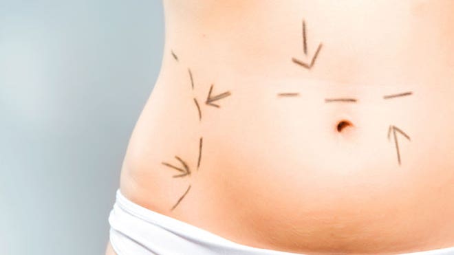 Brazilian Tummy Tuck