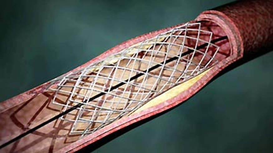 Heart Stent