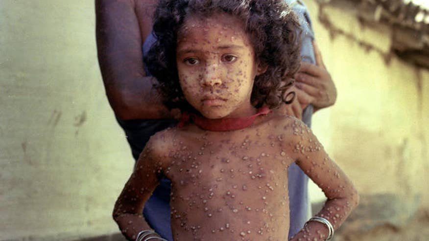 Smallpox