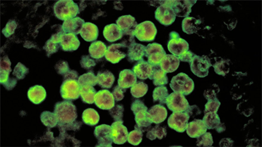Amebic meningoencephalitis due to Naegleria fowleri