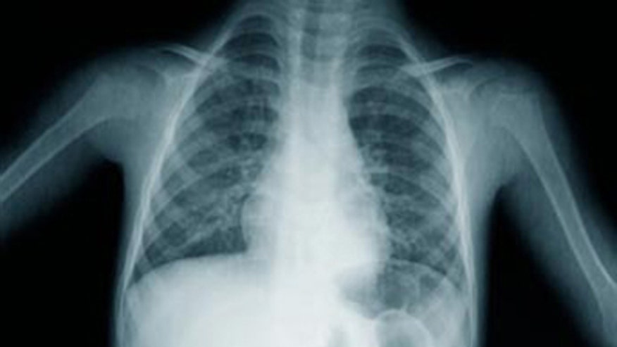 lung x-ray