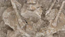 In a necropolis in Spain, archaeologists have found the remains of a Roman woman who died in her s with a calcified tumor in her pelvis, a bone and four deformed teeth embedded within it