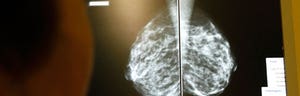 The incidence of metastatic breast cancer – the most advanced stage of the disease – is on the rise in younger women between the ages of and , an analysis of breast cancer trends revealed