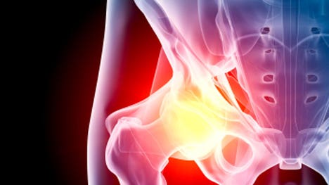 Eighty percent of people over the age of  have X-ray findings of arthritis somewhere: The most common joints are fingers, wrist, hip, knee and spine. In fact, arthritis is the number one reason for disability in the U.S.Here are the six “Ps” of arthritis that you should be aware of