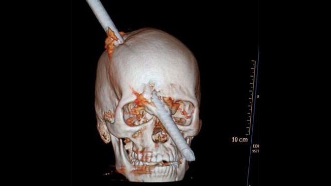 bar through skull 2