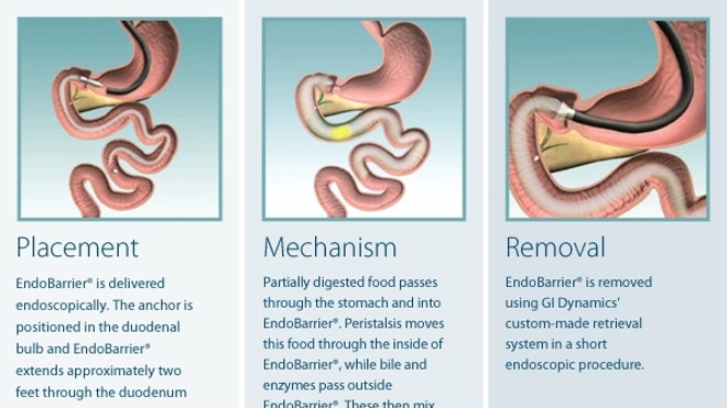 EndoBarrier2.JPG