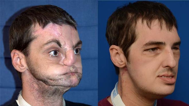 Full Face Transplant Before and After Full Face Transplant Before and After