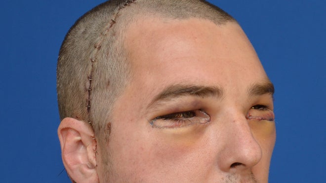 Richard_aftersurgery.jpg