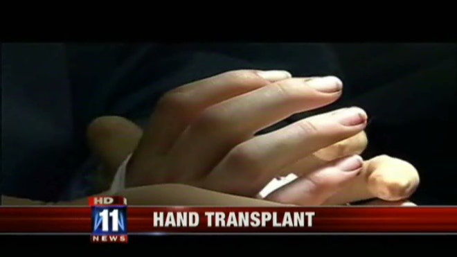 Hand Transplant Ucla