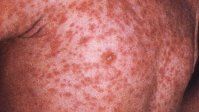 measles