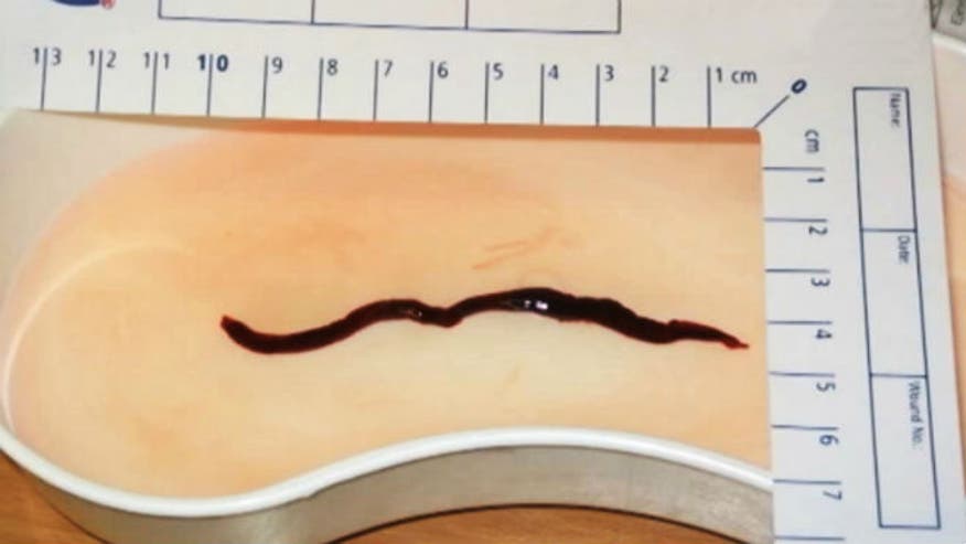 Parasitic worm eats woman’s kidney, kills her KidneyWorm_CEN