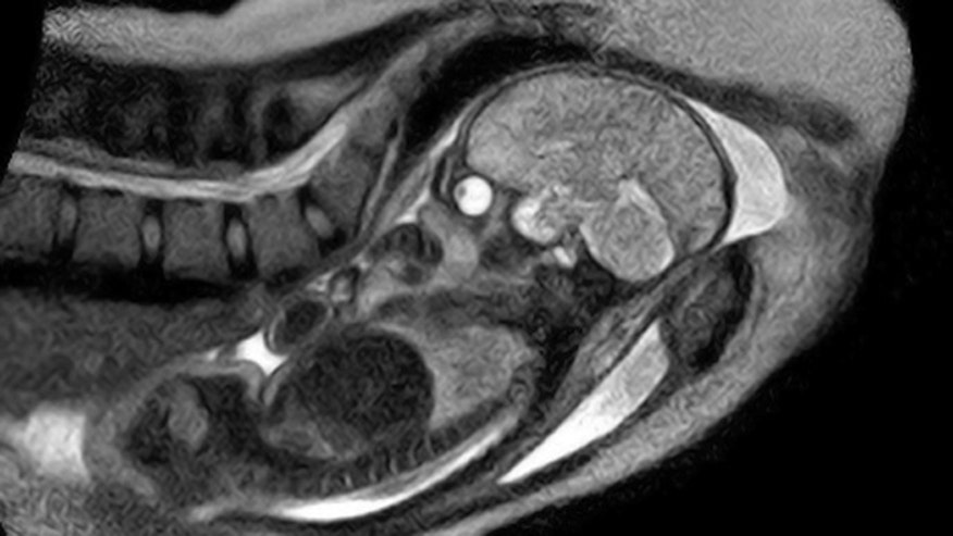 MRI Birth