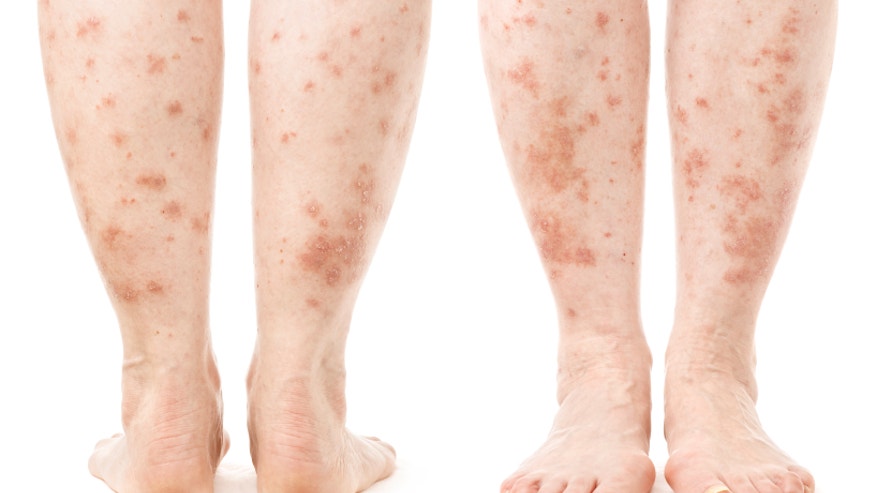 PSORIASIS.jpg