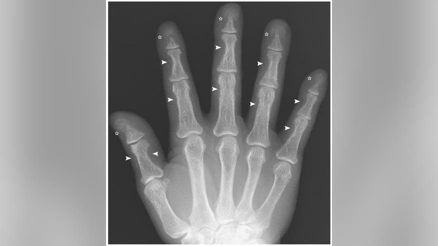 bone-resorption.jpg