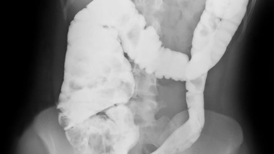 Crohn's disease