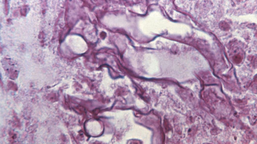 mucormycosisNew.jpg