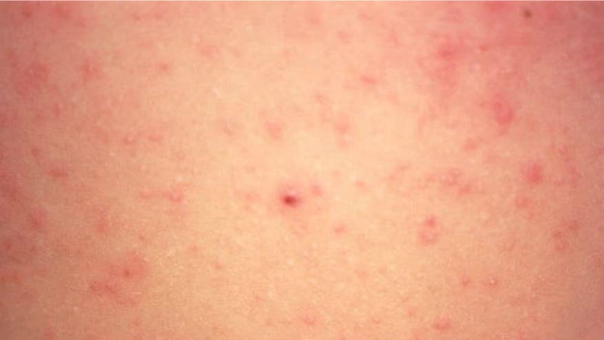 Immigrant Illness What You Need To Know About Scabies And Tuberculosis