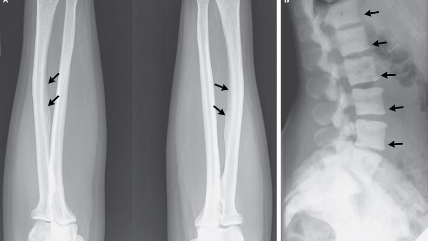 skeletal-fluorosis-130320.jpg