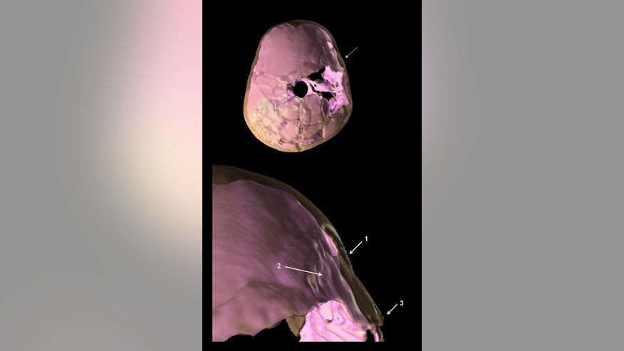 skull-fracture.jpg