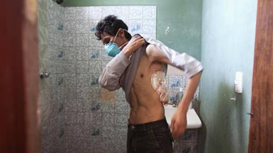 Tuberculosis