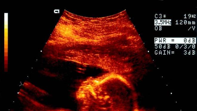 sonogram