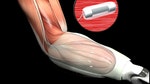 Big breakthroughs may restore a sense of touch to U.S. military personnel who have lost limbs in service of the country.