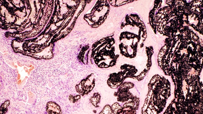 Removing a Tumor, Carefully