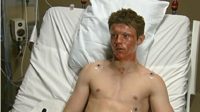 burnvictim