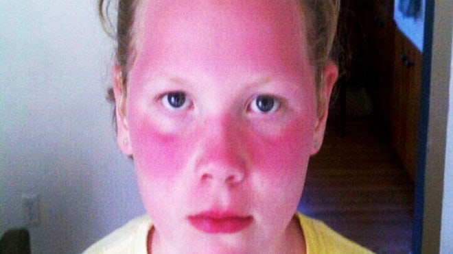 wash mom red fair-skinned daughters returned home school severely sunburned wash mom red fair-skinned daughters returned home school severely sunburned