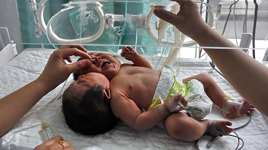 China's Conjoined Twins in Incubator AP