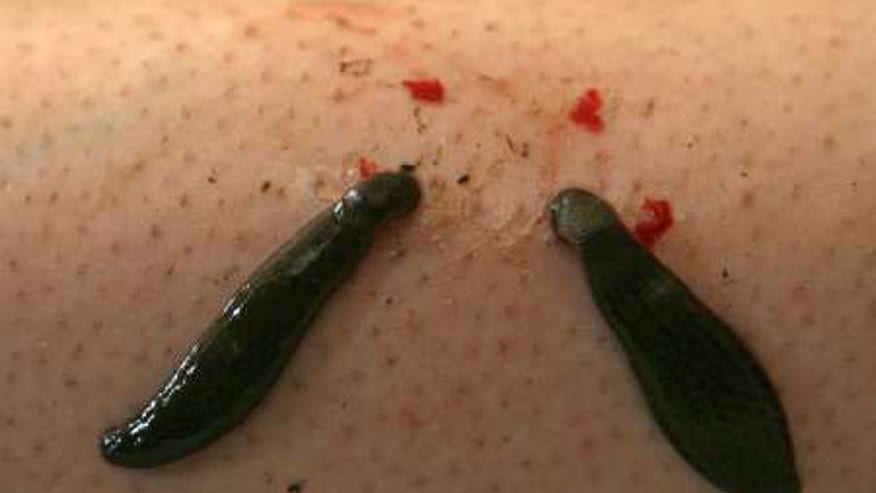 leech