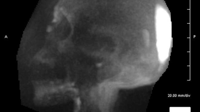 mummy-skull-disease-2