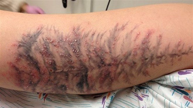 tattoo weight loss arm on News Ink Tattoo Say Causes Infections, Investigators Latino Fox tattoo weight loss arm on News Ink Tattoo Say Causes Infections, Investigators Latino Fox