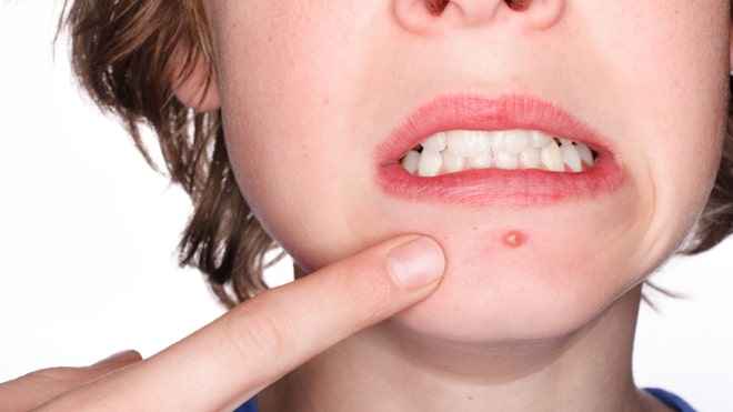 Don't Stress About Acne