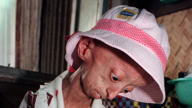 Progeria
