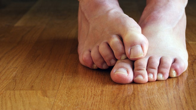 Toenail Fungus