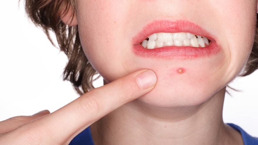 Don't Stress About Acne